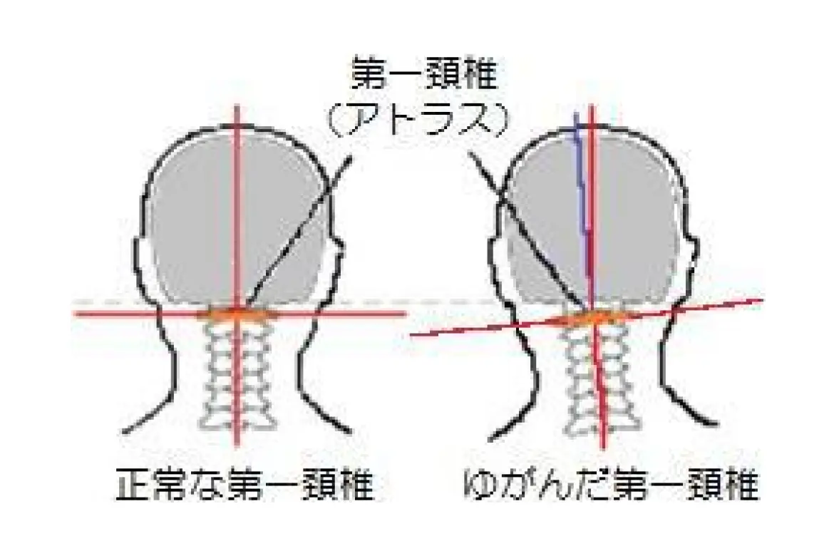 頸椎ヘルニア矯正